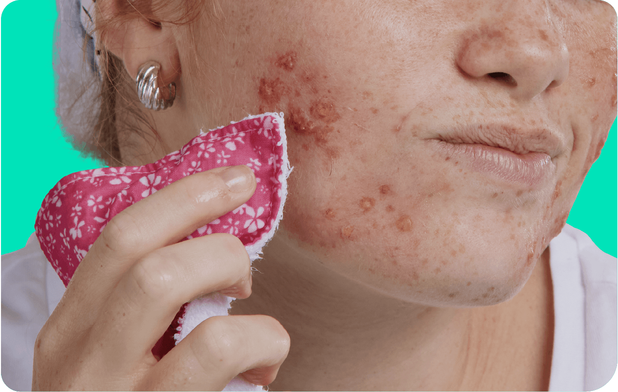 Person holding a pink patterned cloth to their cheek, showing acne and skin redness against a turquoise background.