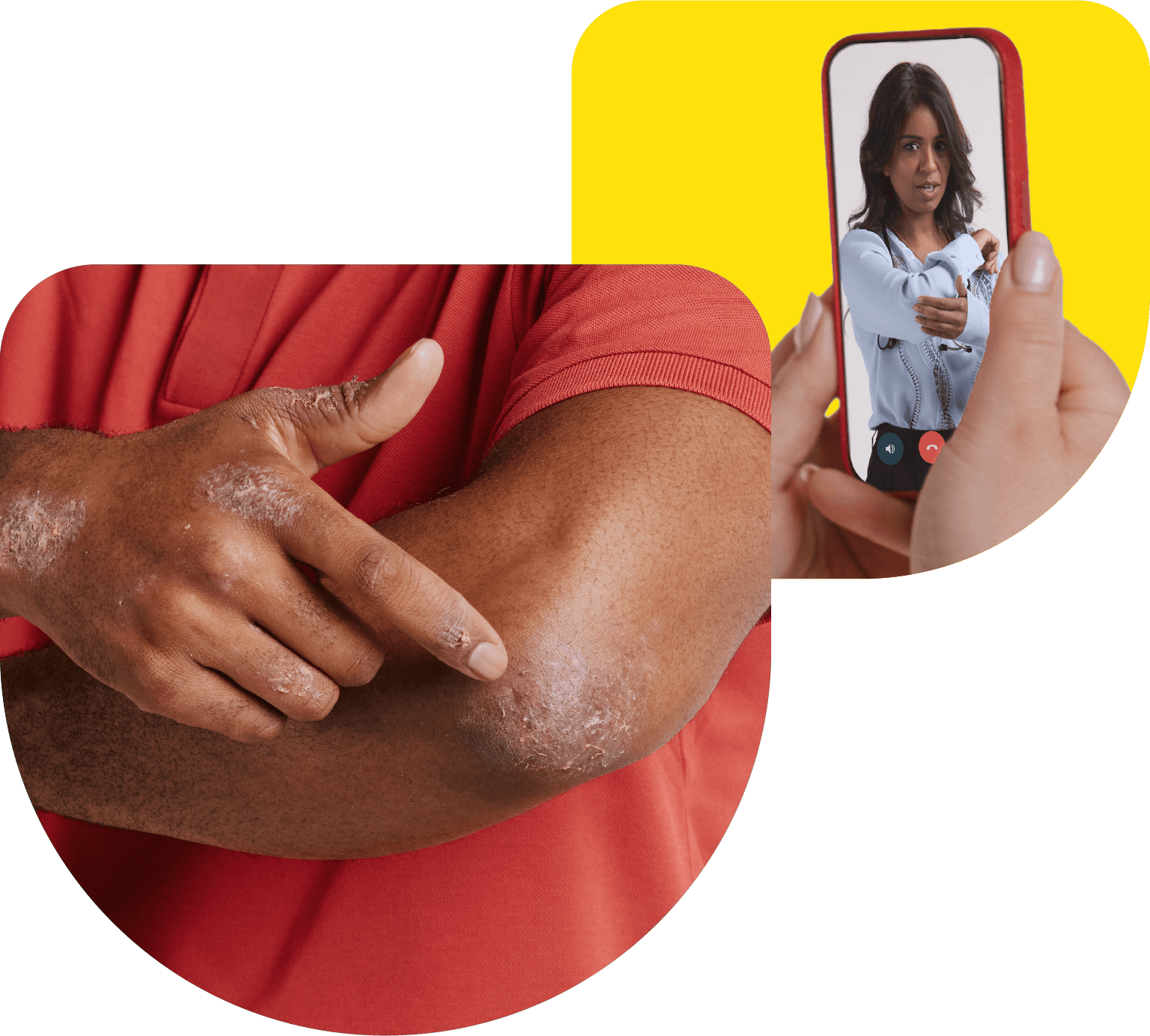Psoriasis Treatment