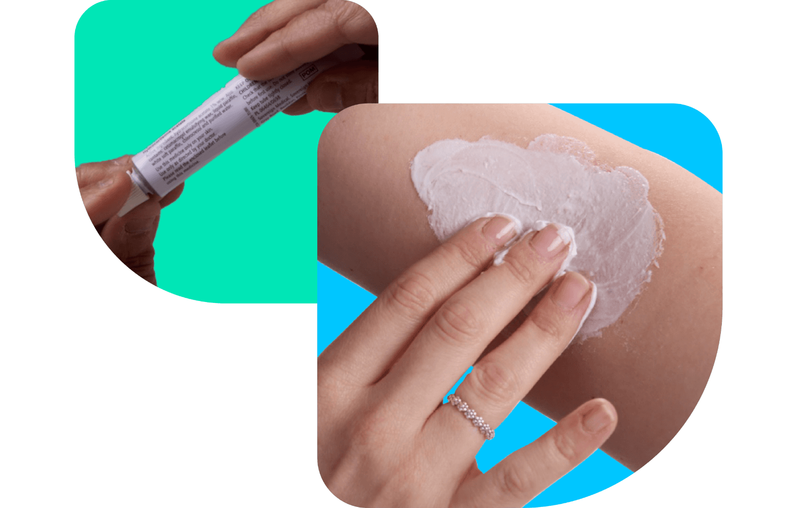 psoriasis cream being applied to the arm