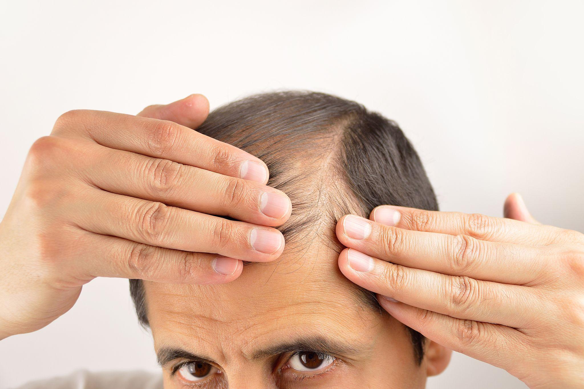 Man examining thinning hair and receding hairline with hands, highlighting hair loss, against a plain white background.
