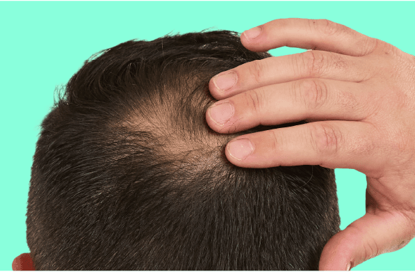 https://a.storyblok.com/f/263052/597x391/4ad8876bdf/hair-loss-2x.png