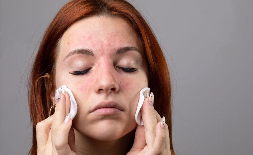 rosacea image, woman cleaning face with cotton pads