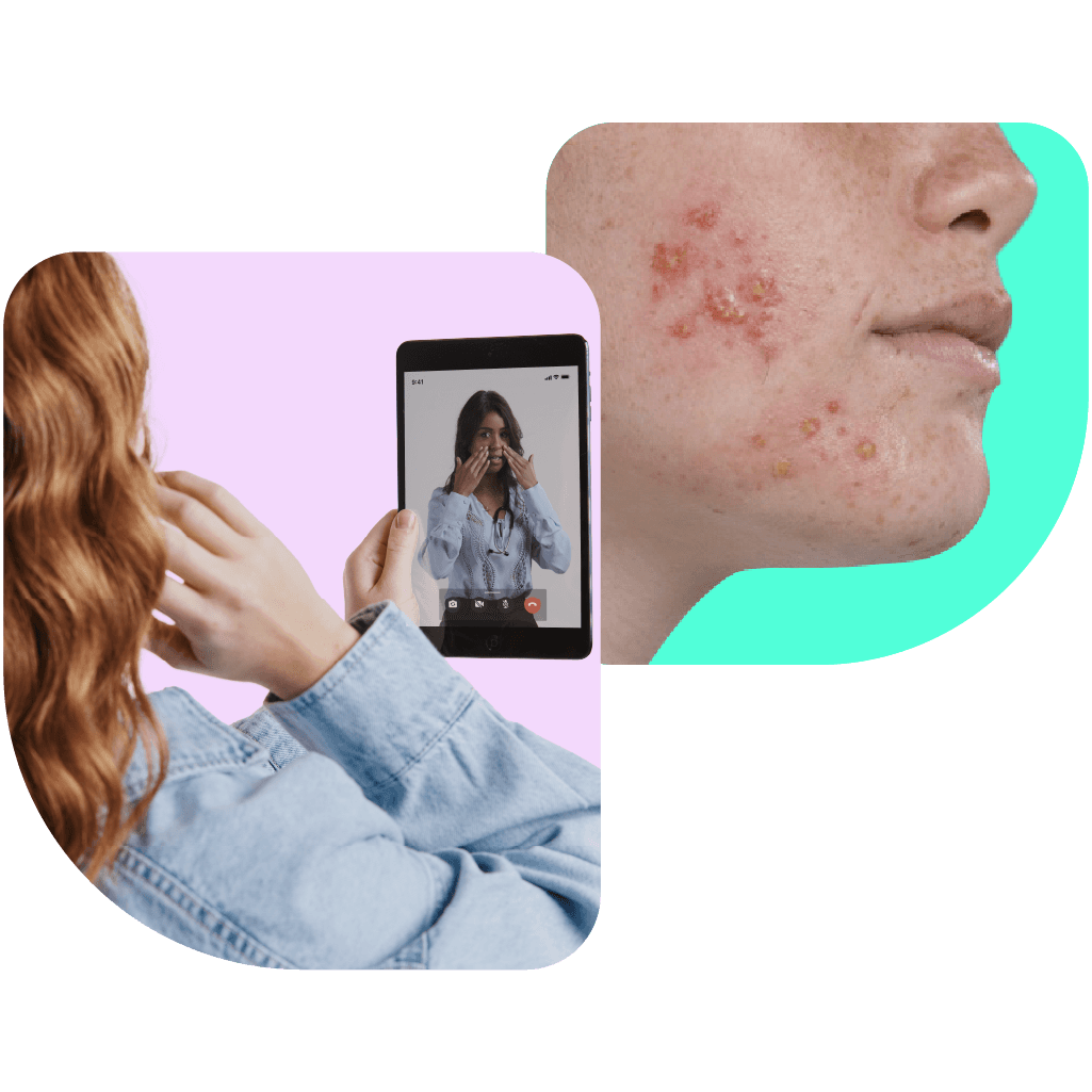 Your acne care, your way