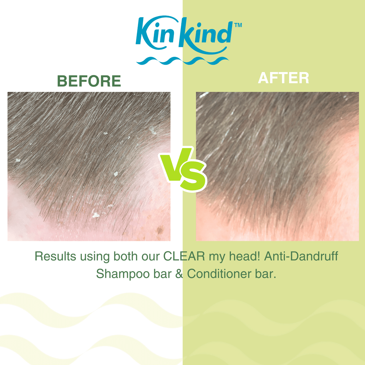 KinKind CLEAR my head! Anti Dandruff Shampoo Bar Apple 50g Image https://cdn11.bigcommerce.com/s-g585yu857h/images/stencil/1280w/products/14362/24950/163872_E__98856.1785920037.png1