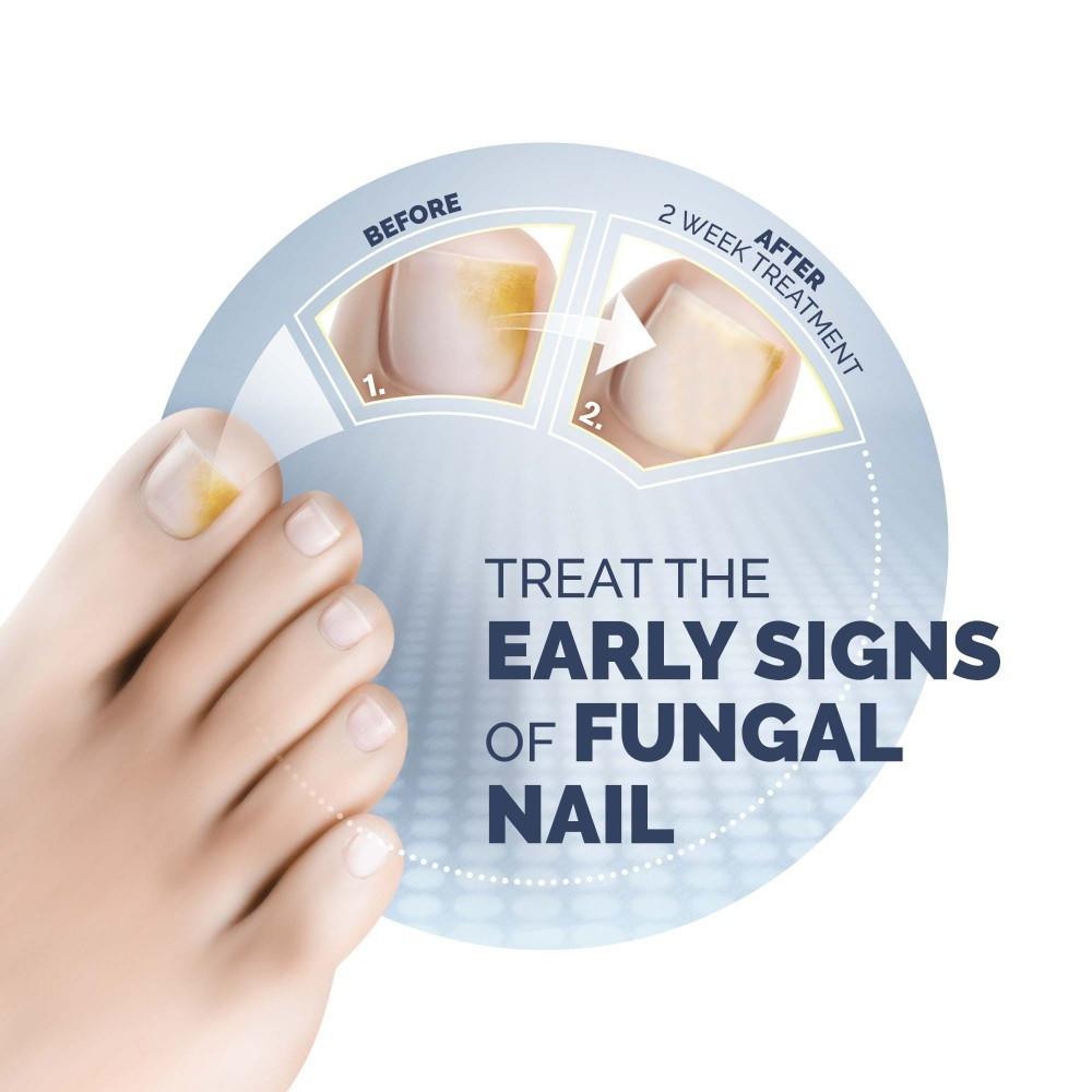 Scholl Fungal Nail Treatment 3.8ml Image https://cdn11.bigcommerce.com/s-g585yu857h/images/stencil/1280w/products/2675/4573/Scholl-Fungal-Nail-Treatment__18748__35899.1740667884.jpg1