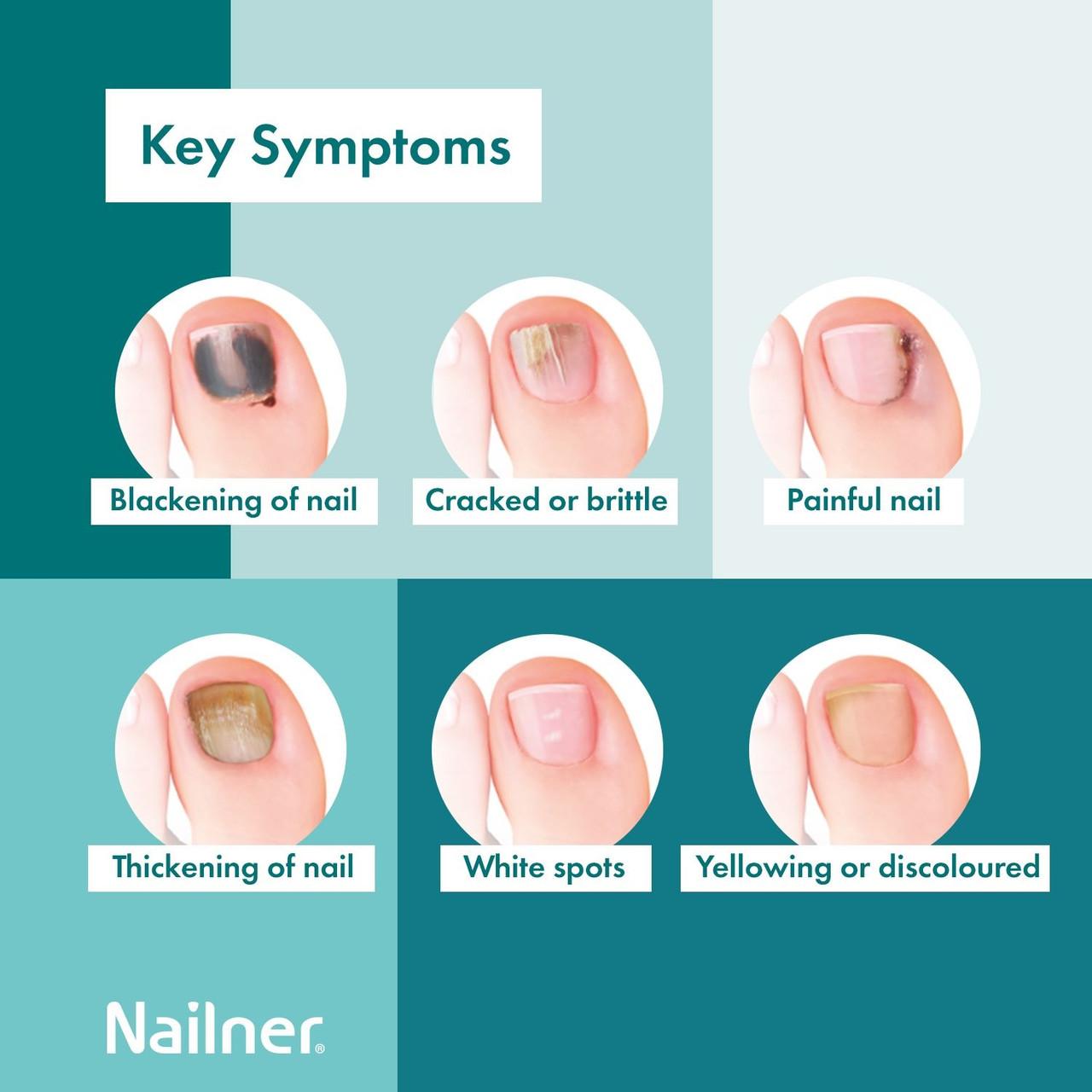 Nailner Fungal Nail Brush 5ml Image https://cdn11.bigcommerce.com/s-g585yu857h/images/stencil/1280w/products/2760/4753/Nailner-Fungal-Nail-Brush__01364__06997.1740667893.jpg1