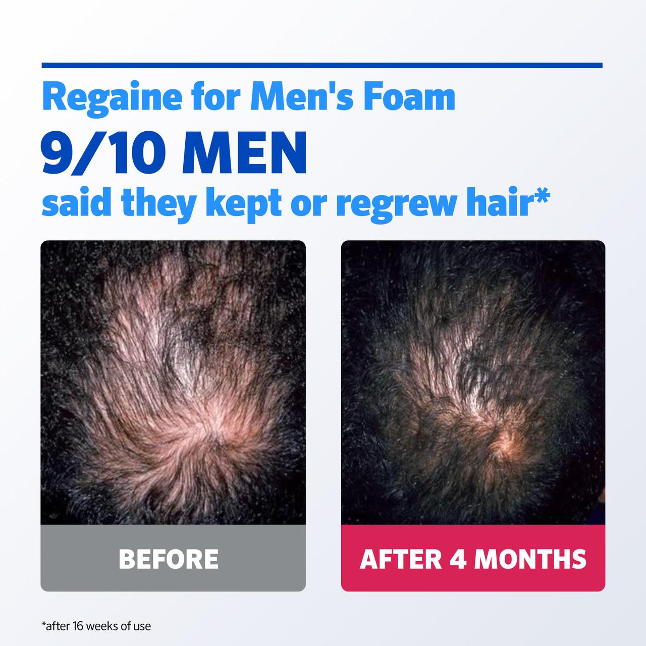 Regaine 5% Extra Strength Hair Regrowth Foam For Men - 3 Month Supply 3x73ml Bottle Image https://cdn11.bigcommerce.com/s-g585yu857h/images/stencil/1280w/products/2912/26070/0068979_G__10611.1768381748.jpg1