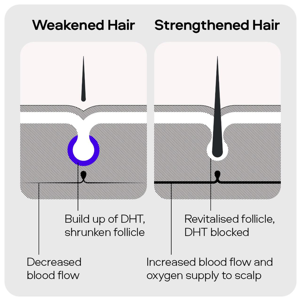 Sons DHT Blocking Hair Growth Shampoo 200ml Image https://cdn11.bigcommerce.com/s-g585yu857h/images/stencil/1280w/products/2932/10651/4234761_05__60387.1740667907.jpg1
