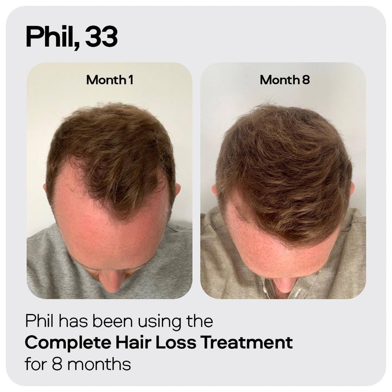 Sons Minoxidil 5% Spray 1 Month Image https://cdn11.bigcommerce.com/s-g585yu857h/images/stencil/1280w/products/2962/10628/4234779_07__57691.1740667907.jpg1