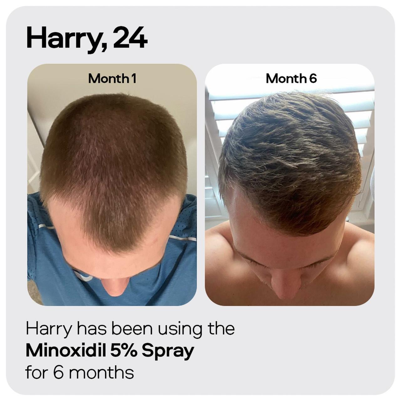 Sons Minoxidil 5% Spray 1 Month Image https://cdn11.bigcommerce.com/s-g585yu857h/images/stencil/1280w/products/2962/10629/4234779_06__69635.1740667907.jpg1