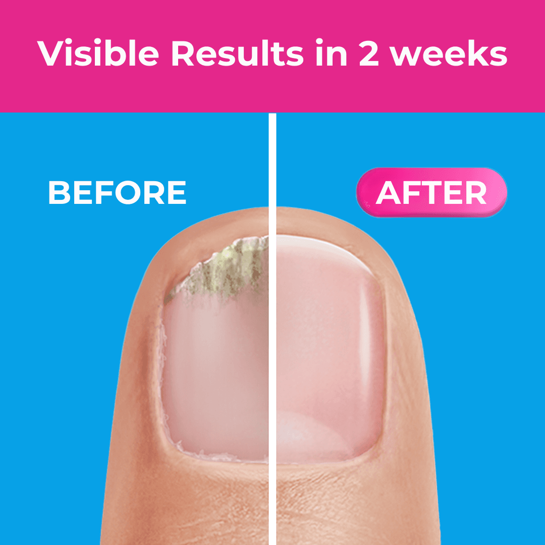 Excilor Solution Fungal Nail Treatment 3.3ml Image https://cdn11.bigcommerce.com/s-g585yu857h/images/stencil/1280w/products/3207/16662/0097509D__18708.1781535981.png1